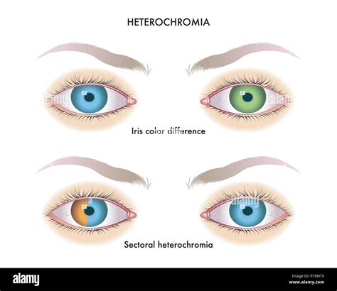 Central Heterochromia Iridis