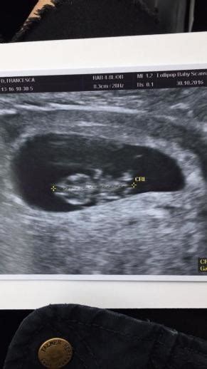 Early Scan Picture Reassurance