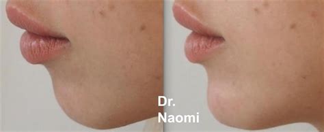 Before And After Dermal Filler Chin Best Clinic Sydney For Dermal Fillers