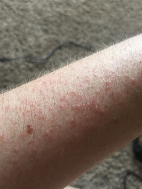 Itchy Bumps On Forearms SexiezPicz Web Porn