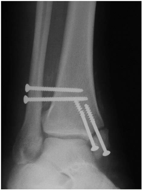 Ankle Fractures Teachme Orthopedics