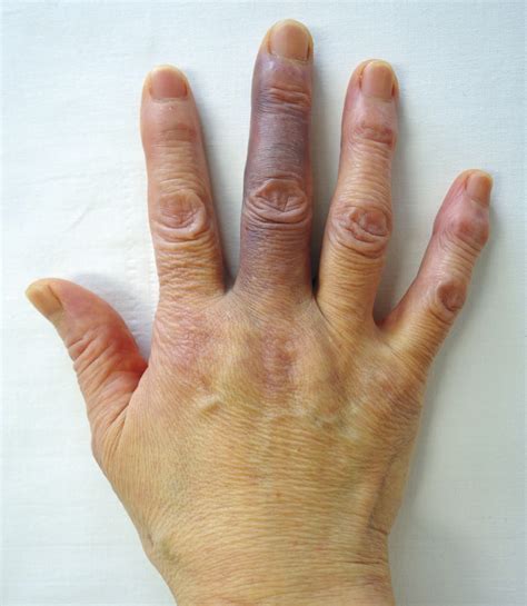 Achenbachs Syndrome Nejm