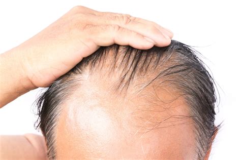 Hair Fall Causes And Treatment For Men