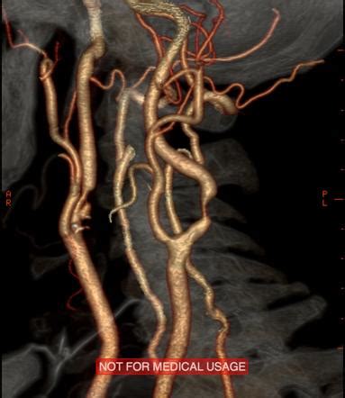 Carotid Artery Stenosis Radiology Reference Article Radiopaedia Org