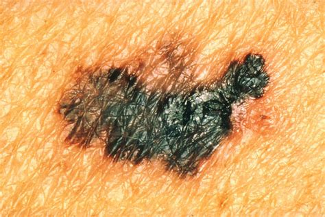 10 Deadly Signs Of Skin Cancer You Need To Spot Early Health7x24