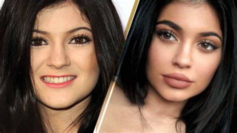 kylie jenner lip fillers plastic surgery before and after photos lipbalmtinted kylie jenner