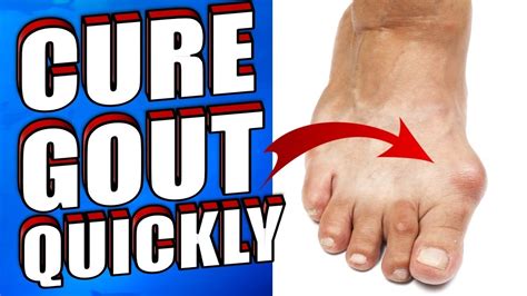 How To Get Rid Of Gout Naturally In 24 Hours Youtube