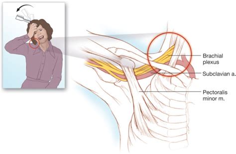 Thoracic Outlet Syndrome Anesthesia Key