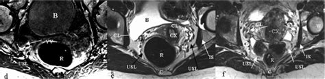 transverse scan in uterine prolapsed women the images demonstrate download scientific diagram