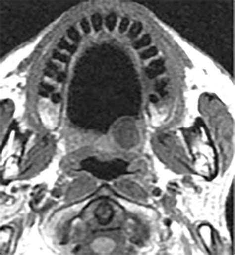 Mri Image Of Oral Squamous Carcinoma Osc Download Scientific Diagram