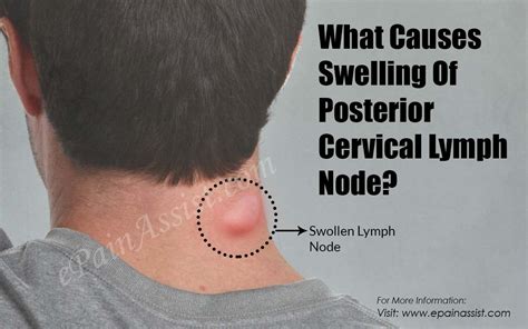 The Gallery For Swollen Occipital Lymph Node
