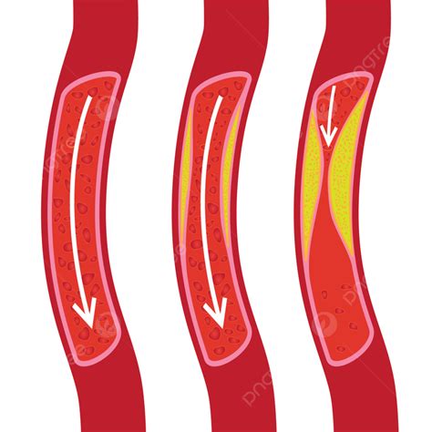 Arteriosclerosis Vector Design Images Healthy Anatomy Aorta Arterial