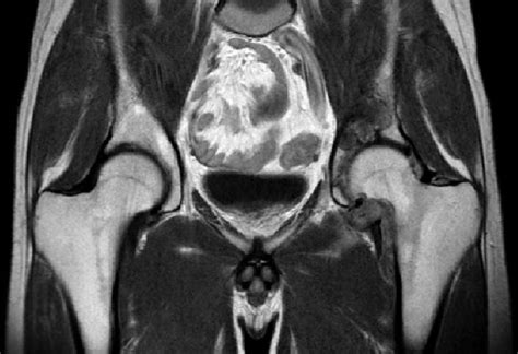 Mri Of The Hip The Synovium Is Diffuse At The Hip With Bone Invasion