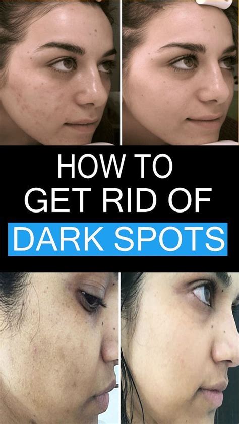 Best Natural Home Remedies For Eliminating Brown Spots On Face In 2022 Dark Spots On Skin