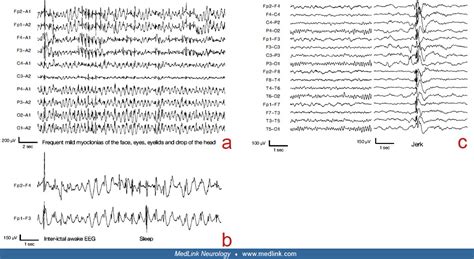 Epilepsy With Myoclonic Atonic Seizures Medlink Neurology