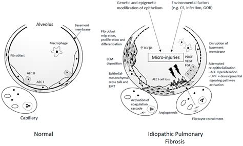 Idiopathic Pulmonary Fibrosis Pathogenesis