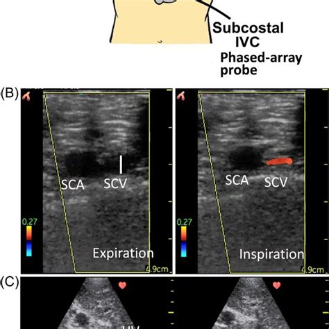 Ultrasound Probe Positions And Ultrasound Images Of The Subclavian Vein