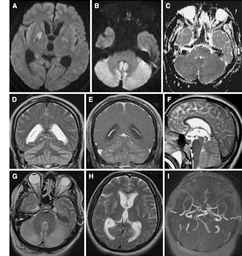 Brain Mri Dwi Shows Prominent Hyperintensities In The Basal Ganglia