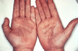 Hand Fungus Symptoms Causes Pictures And Treatment