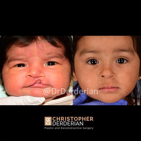Cleft Palate Surgery And Cleft Lip Repair Near Me Dallas Texas Dr
