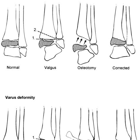 Illustrations Of The Steps Of A Transphyseal Distal Tibial Osteotomy