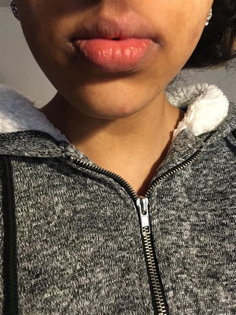 How Do I Get Rid Of The Discolouration Around The Corners Of My Mouth