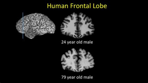 News Hub Humans Alone In Brain Shrinkage With Age