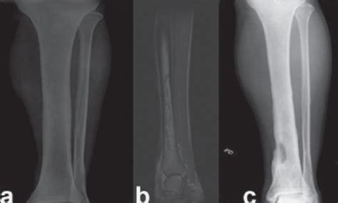 Figure 0004burkholderia Pseudomallei Musculoskeletal Infections