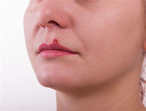 A herpes tzanck smear shows enlarged nuclei that occupy most of the cell. Herpes Simplex Virus Oral Herpes Cold Sores Genital Herpes Treatment