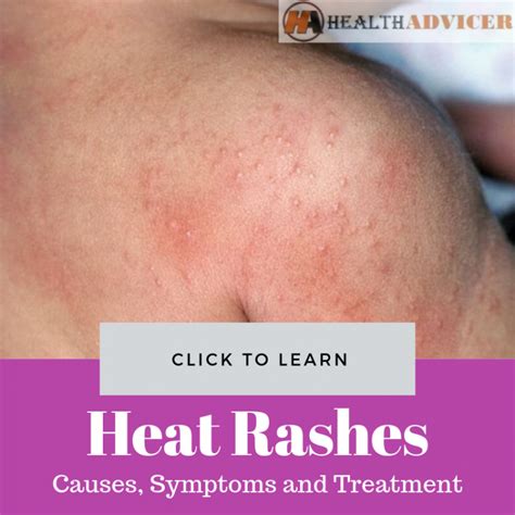 Heat Rashes In Babies Everything You Need To Know Heat Rash Baby Riset