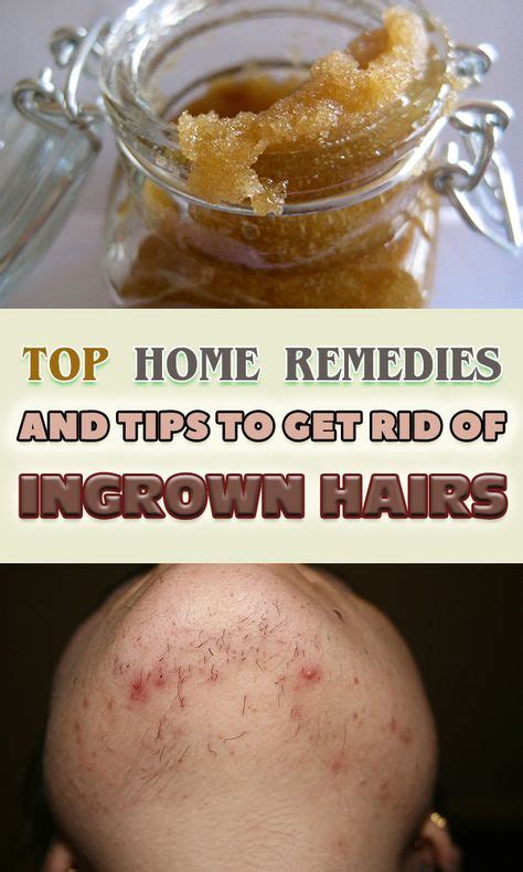Top Home Remedies And Tips To Get Rid Of Ingrown Hairs Ingrown Chin
