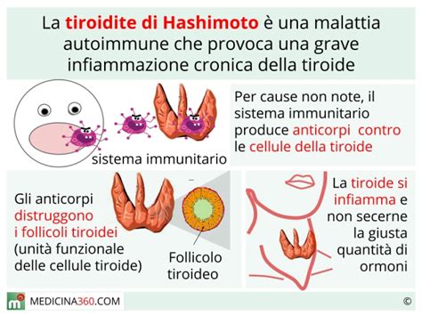 Tiroidite Di Hashimoto Sintomi Cause Dieta Cura E Conseguenze