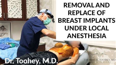 Removal And Replace Of Breast Implants In The Office Under Local