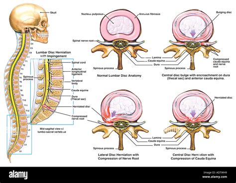 What Is Lumbar Herniated Disc How Does It Aggravate Sciatica Images