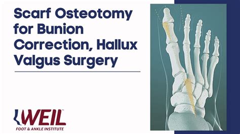 Scarf Osteotomy For Bunion Correction Hallux Valgus Surgery Weil