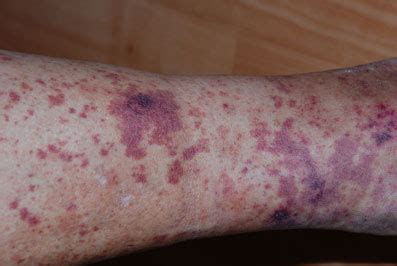 The word is derived from latin 'petigo', meaning 'scab' or 'eruption'. Scheurbuik | huidinfo.nl | informatie van de dermatoloog