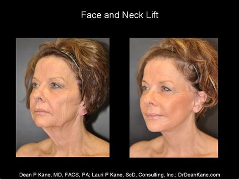 This 63 Year Old Came To Dr Kane Initially For Fillers She Received