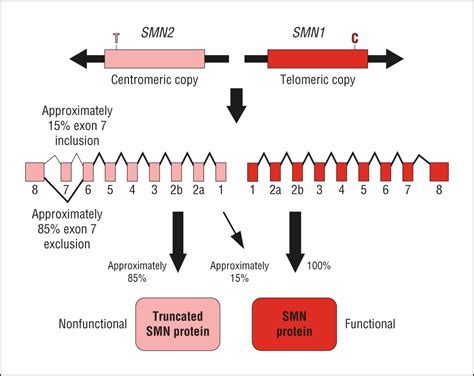Spinal Muscular Atrophy A Timely Review Genetics And Genomics Jama