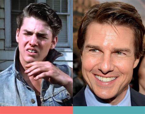 10 Stars Whose Braces Before And After Images Define Hollywood Smile