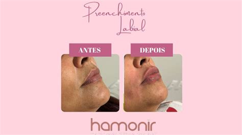 Preenchimento Labial Ml O Necess Rio Confira O Antes E Depois