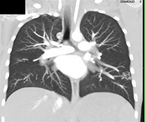 Pulmonary Avm In Left Lower Lung Chest Case Studies Ctisus Ct Scanning