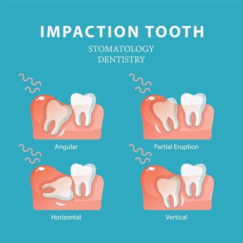 Impacted Wisdom Teeth Can Cause Pain Swollen Gums And Swelling Around