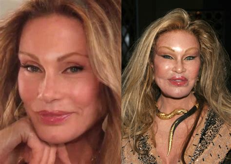Most Expensive Plastic Surgery In Hollywood - Plastic Industry In The World