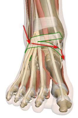 When you have pain on the top of your foot it is often an arthritic bone spur. pain across outer ankle, top of foot over to arch