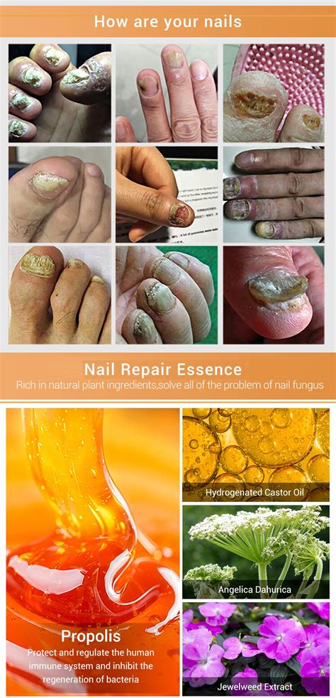 8pcs Nail Fungus Treatment Serum Onychomycosis Paronychia Anti Fungal Nails Infection Herbal Toe