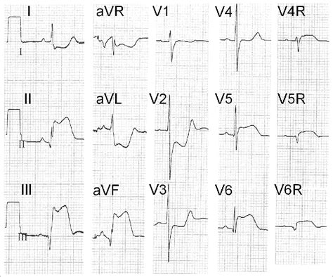 Ecg Shows Inferoposterior St Elevation Myocardial Infarction Of The