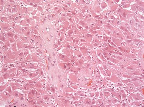 Subependymal Giant Cell Astrocytoma Pathophysiology Wikidoc