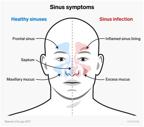 The 5 Best Home Remedies For A Sinus Infection Insider