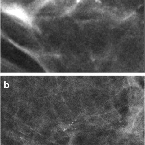 The Morphology Of Calcifications On Synthetic Mammograms Generated From Download Scientific