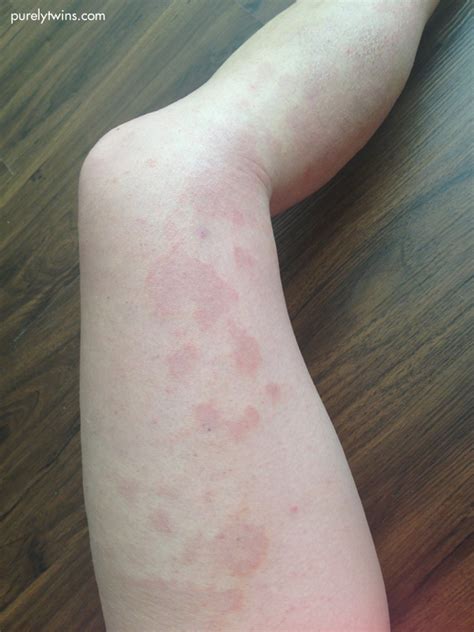 Eczema Update What The Doctor 1 Said And Products That Are Helping